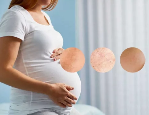 Bà bầu bị sạm da