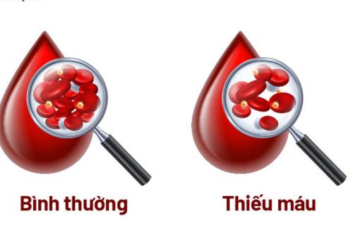 thiếu sắt cơ thể sẽ như thế nào