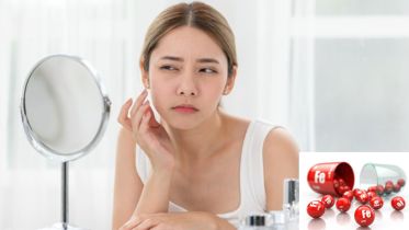 uống sắt có bị nổi mụn không