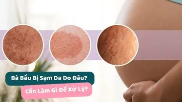 Bà bầu bị sạm da phải làm sao