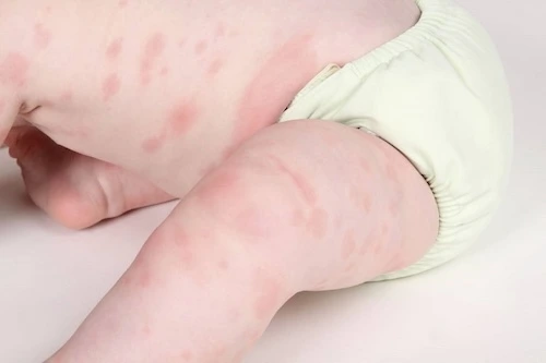 ho dị ứng thời tiết ở trẻ em