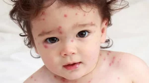 Nguyên nhân khiến trẻ bị mụn nhọt