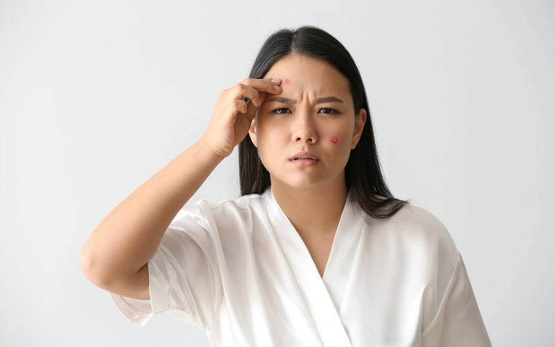 Tinh trang mun trung ca khi mang thai co dang lo 

