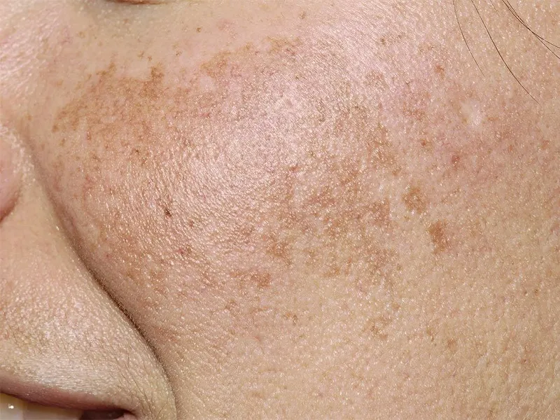 bà bầu bị nám da