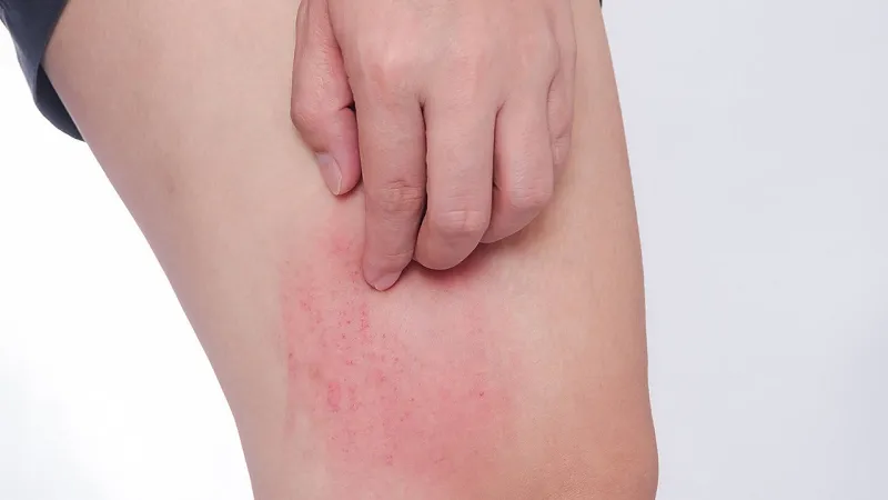 Mang thai bị ngứa khắp người