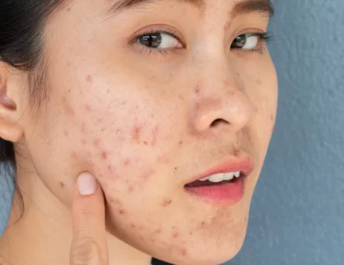 Top 6 san pham ngua mun cho ba bau Lua chon diu nhe ho tro lan da khoe manh