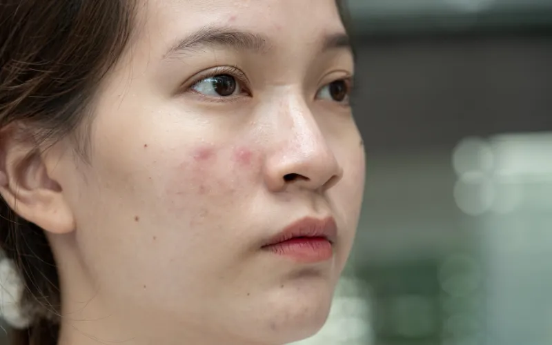 Mun trung ca viem mun boc mun mu mun viem 