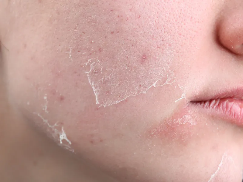 Tại sao cần dùng serum dưỡng ẩm cho bà bầu 
