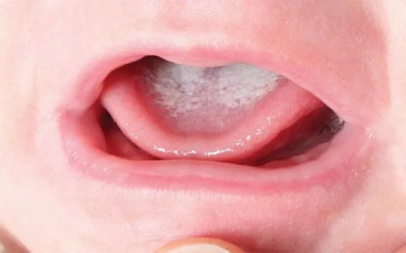 Nam Candida Albicans
