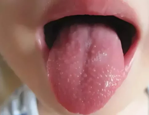 Be bi rop luoi phai lam sao Huong dan chi tiet cho cha me