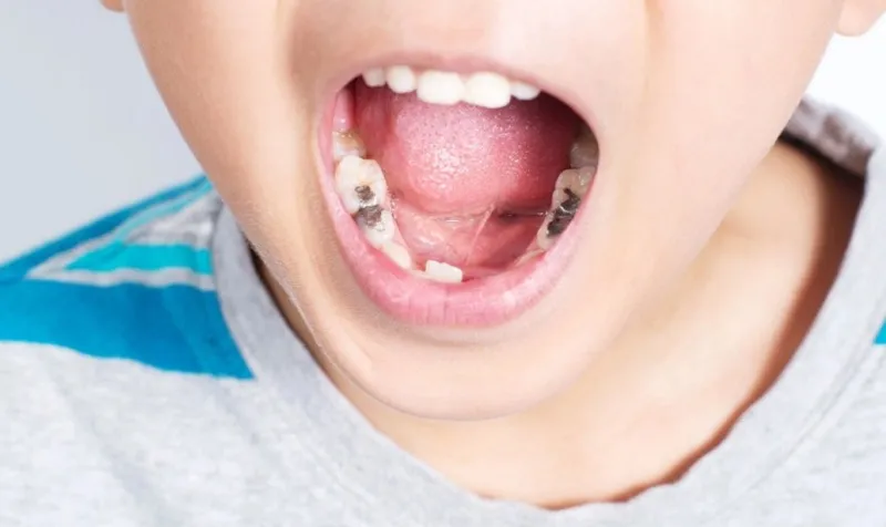 Vì sao bé dễ bị sâu răng sữa?