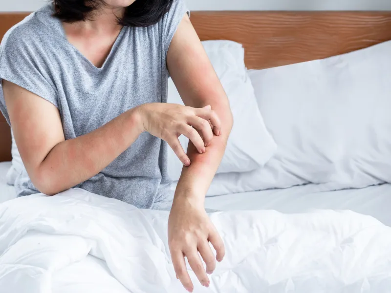 Da dị ứng (Allergic contact dermatitis)