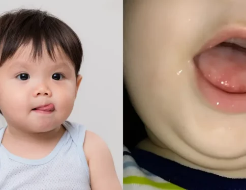 Luoi be bi dom do Nguyen nhan cach xu ly hieu qua