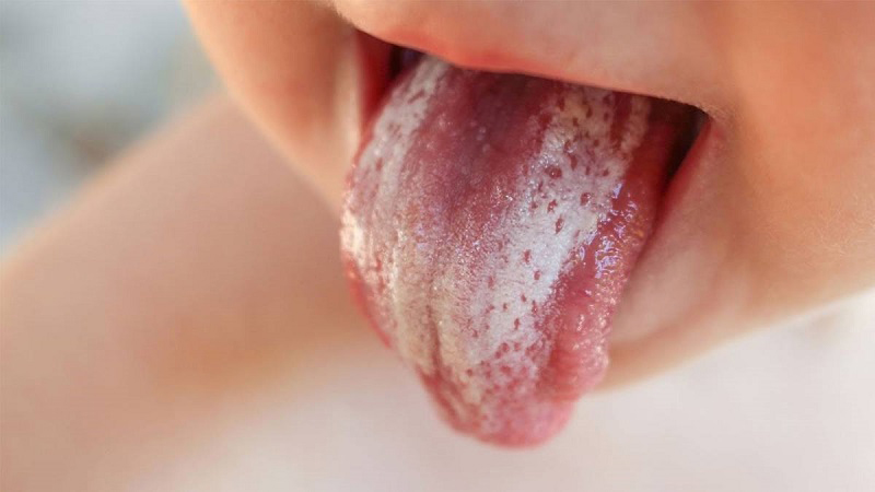 Lưỡi bé bị đốm trắng là bị gì?