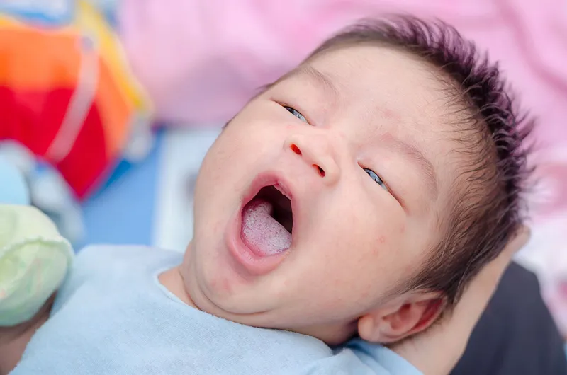 Cách xử lý khi lưỡi bé bị đốm trắng