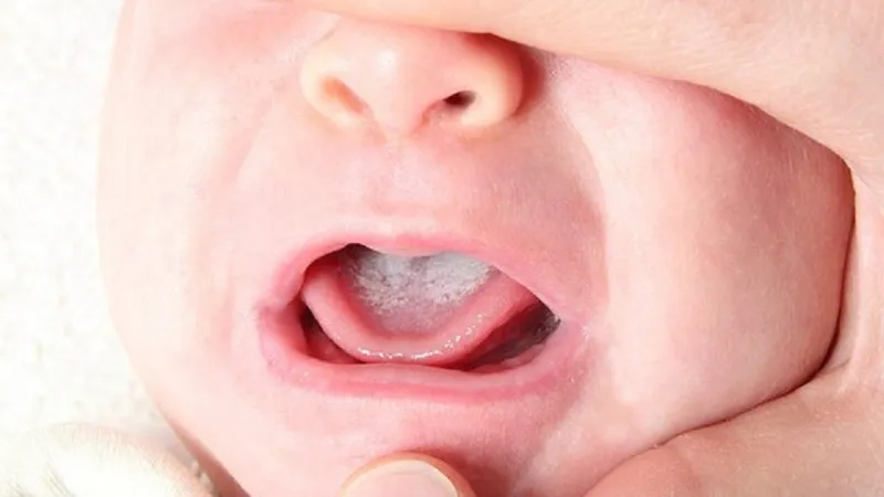 Nấm miệng do nấm Candida