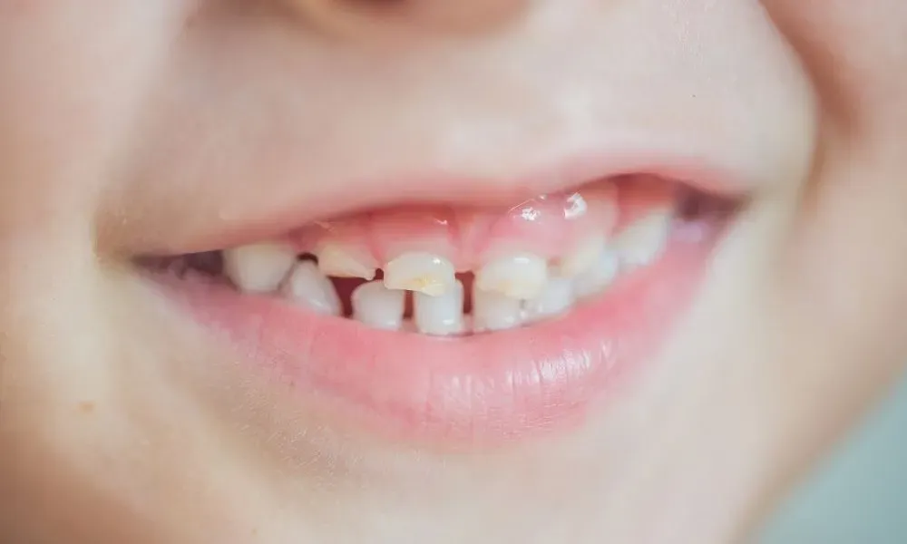 Vì sao răng bé bị mòn?
