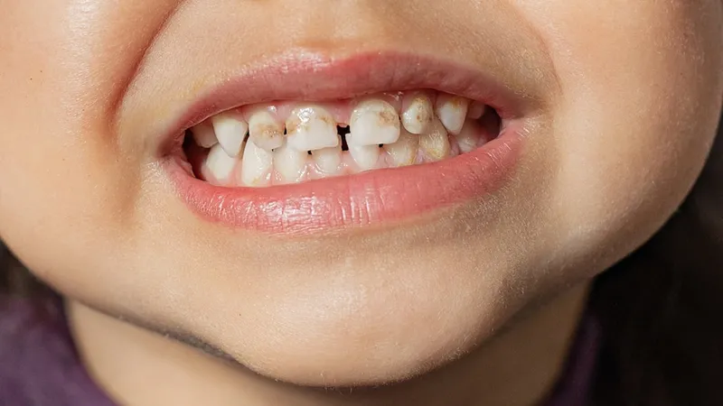 Nguyên nhân khiến răng bé bị trắng đục