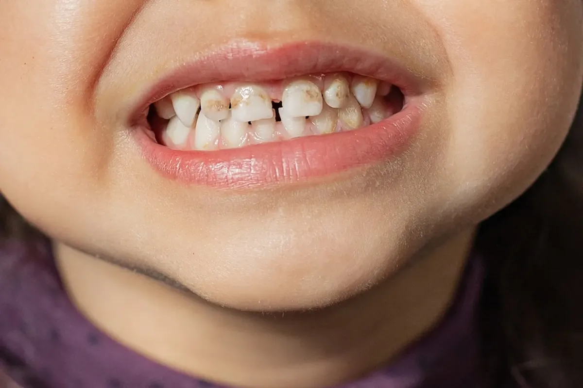 Tại sao cần chú ý khi răng sữa của bé bị xỉn màu