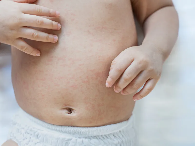 Da bé bị nổi sần như da gà là gì?