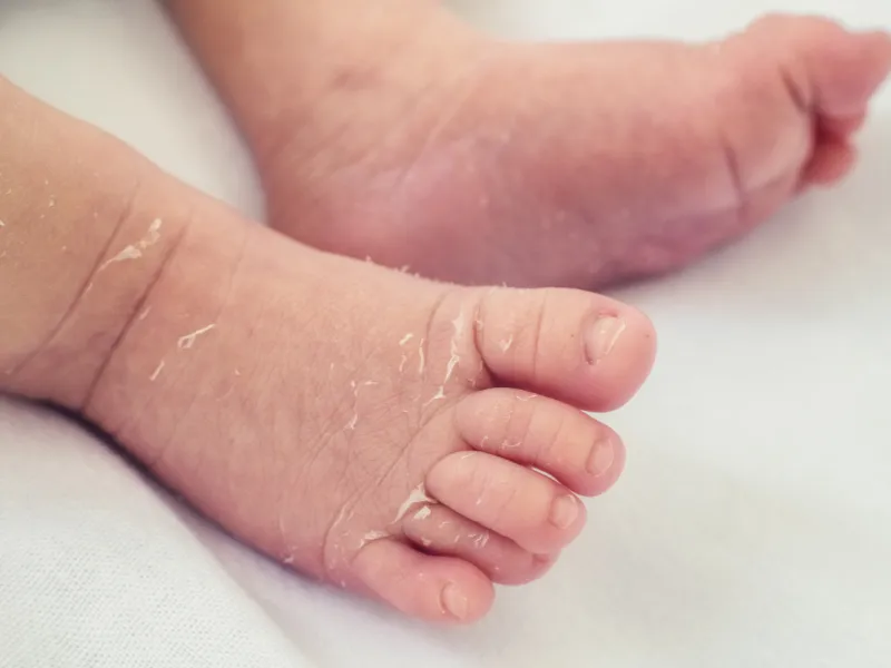 Nguyên nhân khiến da bé bị nổi sần như da gà