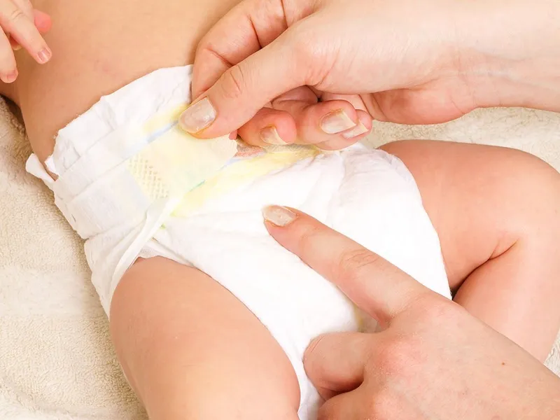 Lời khuyên phòng ngừa hăm tã cho bé
