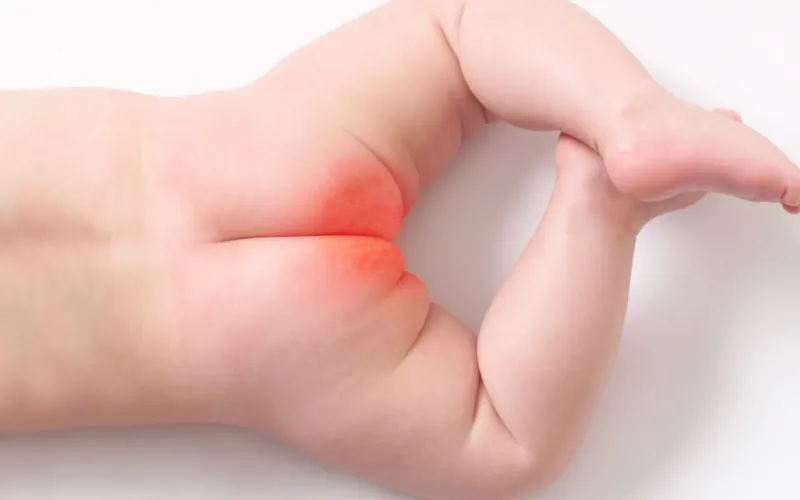Trẻ bị hăm đỏ hậu môn là gì?
