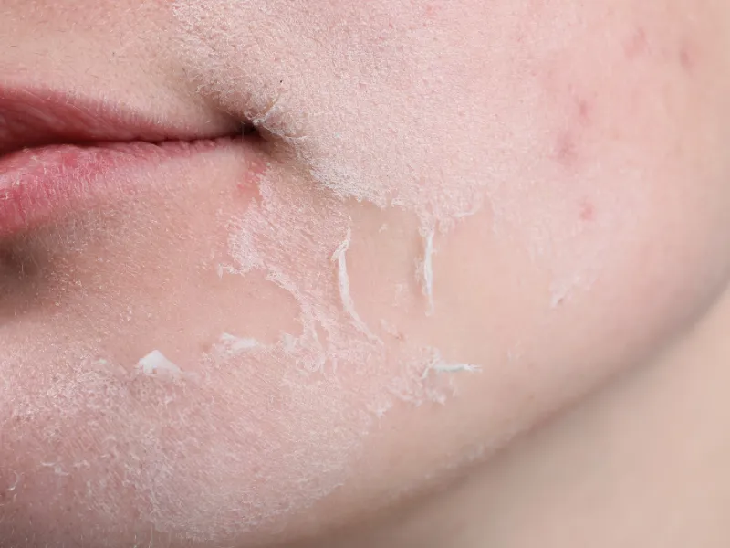 Hỗ trợ giảm viêm và làm dịu da