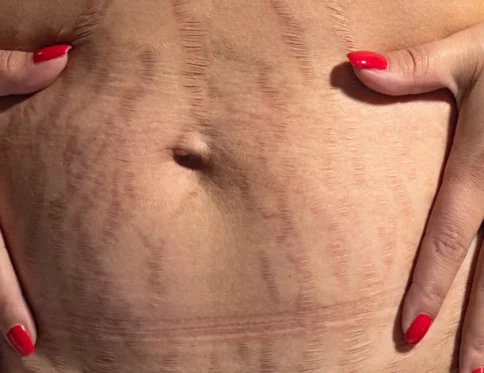 Bị rạn da màu đỏ có tự hết không