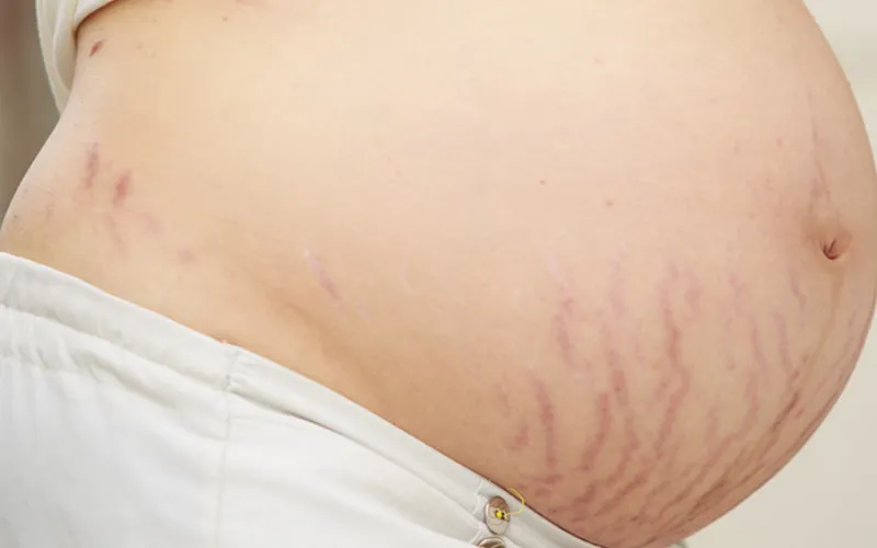 Nguyên nhân gây rạn da màu đỏ