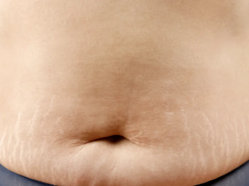 Bị rạn da màu trắng có tự hết không?