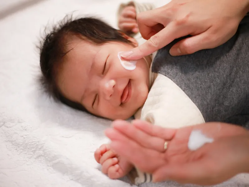 Cách xử lý và phòng ngừa chàm da ở trẻ chuẩn chuyên gia