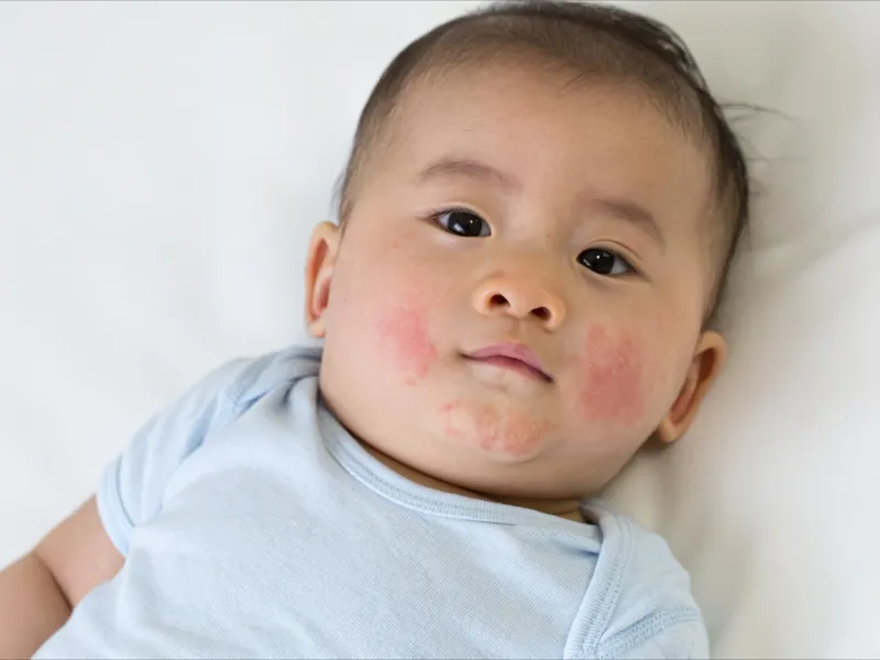 Dấu hiệu chàm da ở trẻ