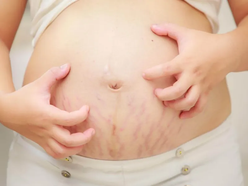 Làm thế nào để hết ngứa vết rạn?