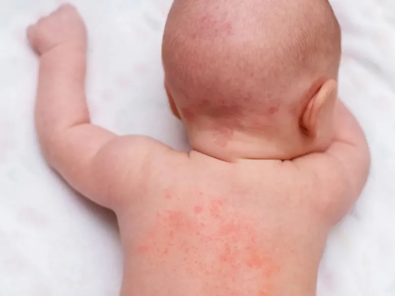 Nấm da ở trẻ sơ sinh là gì?