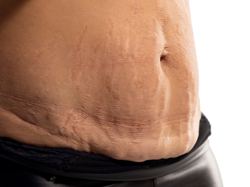 Rạn da khi mang thai có hết không?