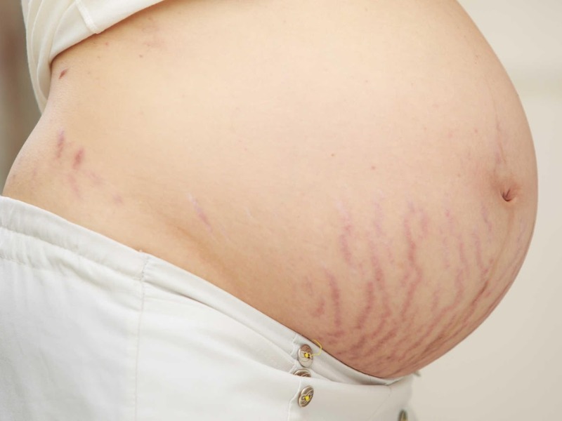 Rạn da khi mang thai là gì?