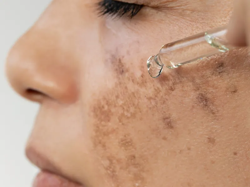 Công dụng của Thiamidol với làn da bà bầu