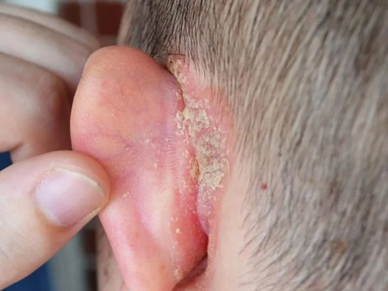 Nguyên nhân vành tai bị đóng vảy ở trẻ