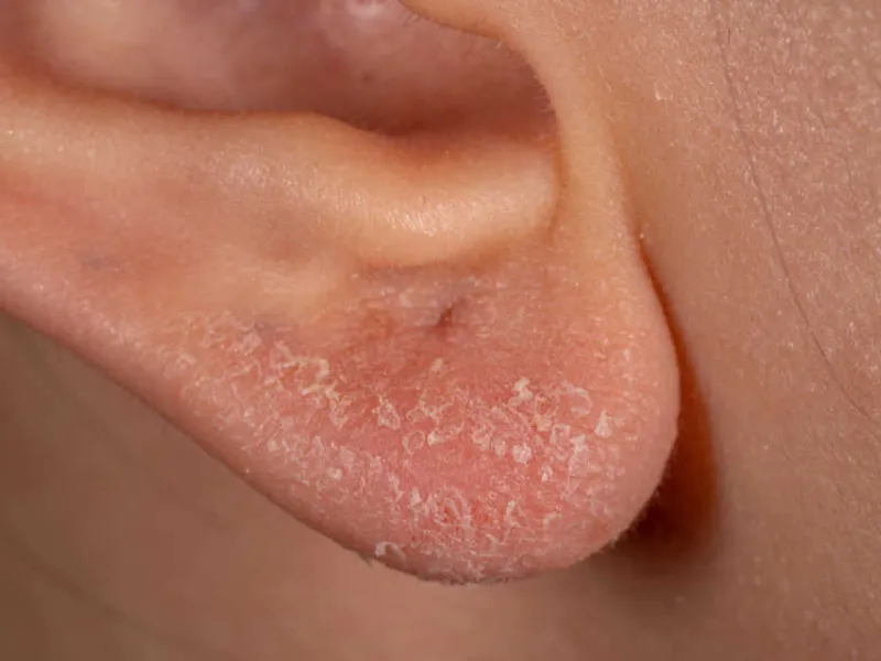 Cách nhận biết vành tai bị đóng vảy sinh lý và bệnh lý ở trẻ