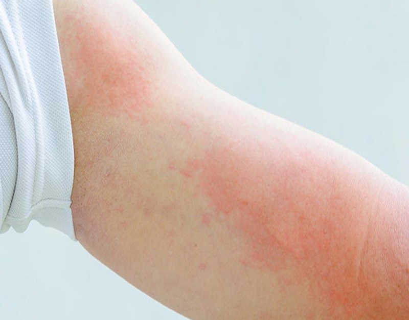 Bệnh da nhạy cảm ánh sáng là gì?