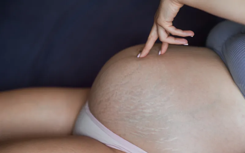 Nguyên nhân khiến phụ nữ sau sinh bị rạn da