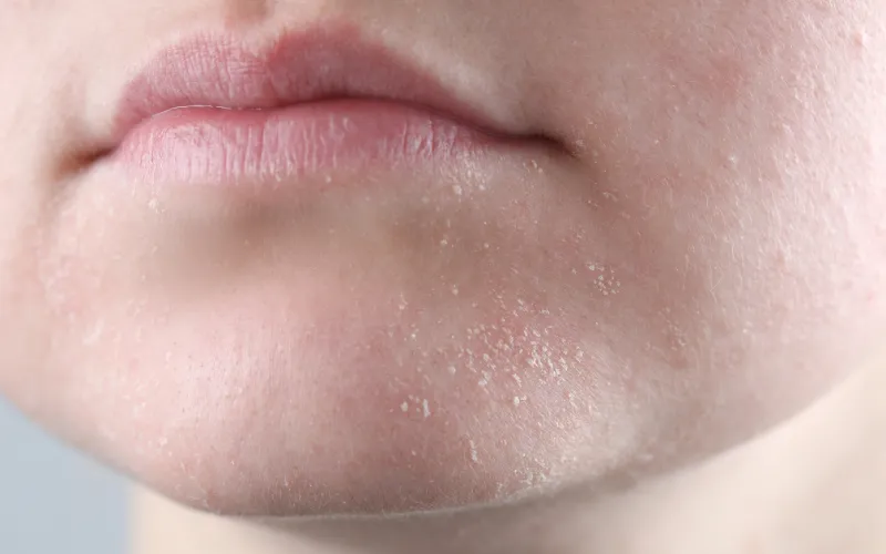 Hiểu đúng về da khô bong tróc