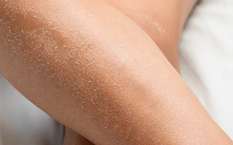 Da khô bong tróc ở mặt khác gì ở chân tay?