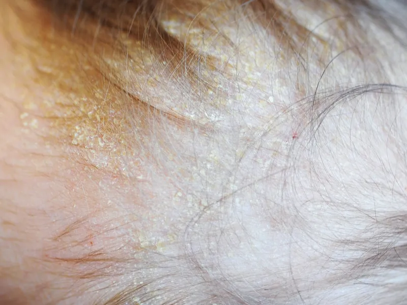 Nấm da đầu ở trẻ là gì?