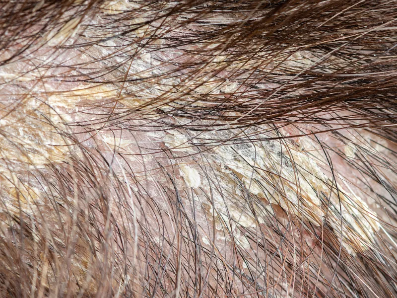 Vì sao trẻ dễ bị nấm da đầu hơn người lớn?