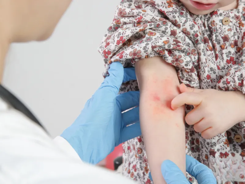 Nguyên nhân sần ngứa ở trẻ thường gặp nhiễm kí sinh trùng