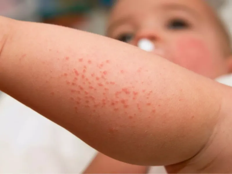 Nguyên nhân sần ngứa ở trẻ thường gặp rôm sảy