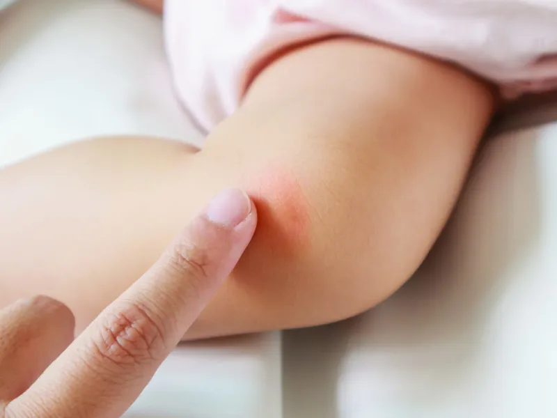 Nguyên nhân sần ngứa ở trẻ thường gặp