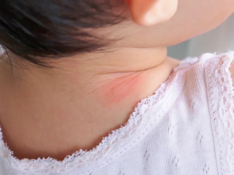 Trẻ bị mẩn ngứa ở cổ là bệnh gì? 